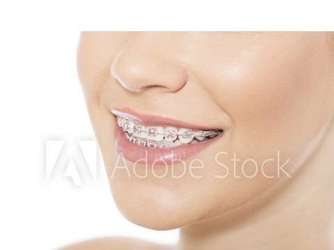 Braces