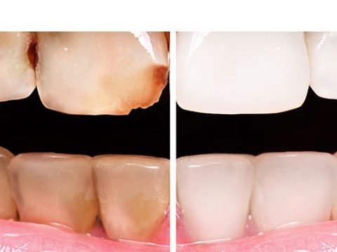 Crowns and Veneers