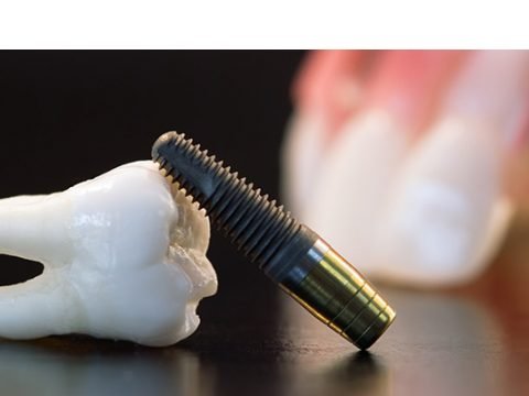 Dental Implants