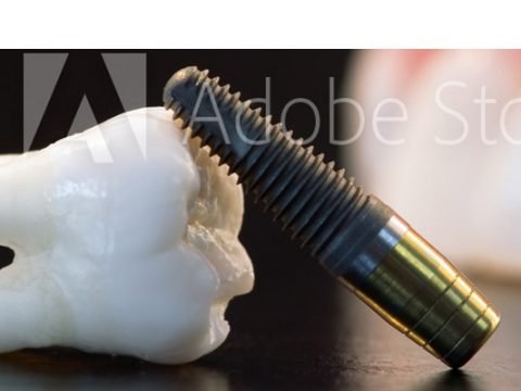 Dental Implants